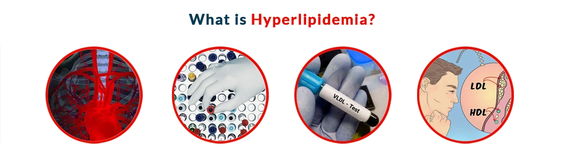 Hyperlipidemia: Causes, Symptoms, Diagnosis, Treatment And Its Effect ...